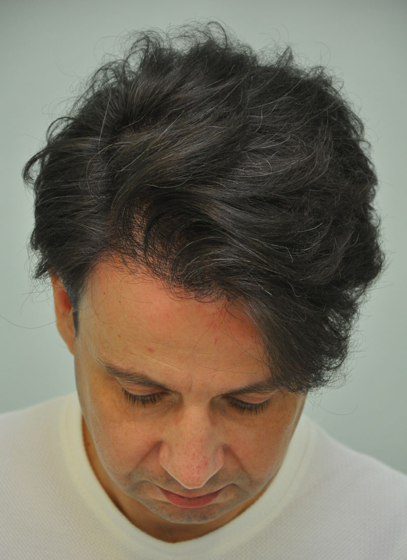 Hajbeültetés páciens utána