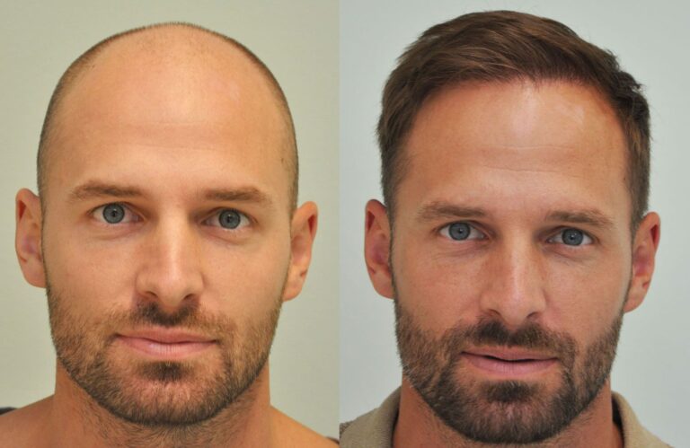 Hajbeültetés előtte-utána fotó a páciensről