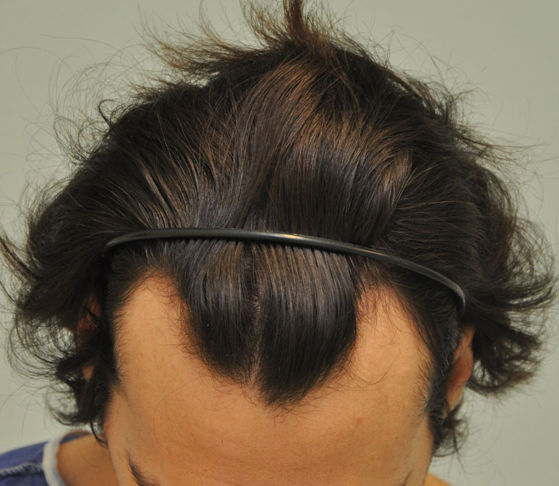 Hajbeültetés páciens előtte