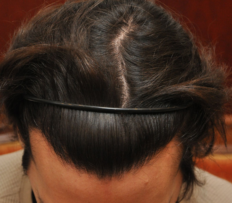 Hajbeültetés páciens utána