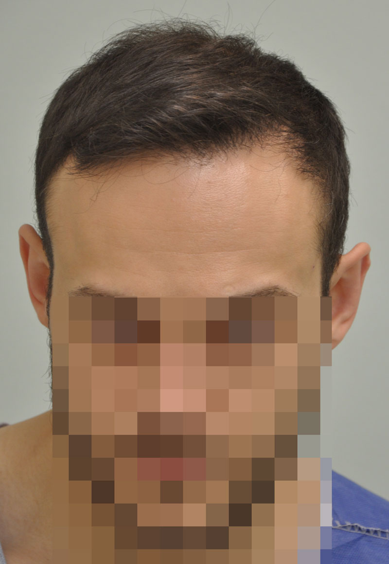 Hajbeültetés páciens utána